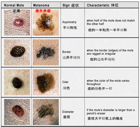 黑痔|有这5种“痣”要小心，可能会恶变